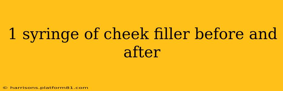 1 syringe of cheek filler before and after
