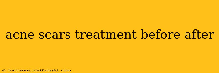 acne scars treatment before after