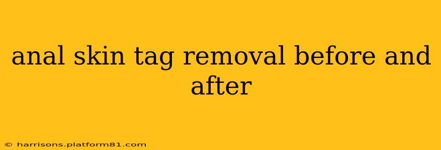 anal skin tag removal before and after