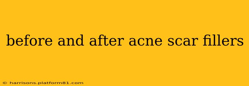before and after acne scar fillers
