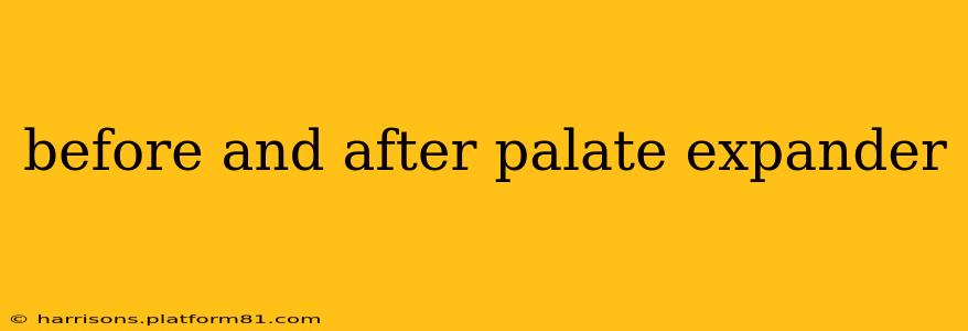 before and after palate expander