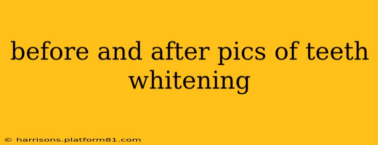 before and after pics of teeth whitening