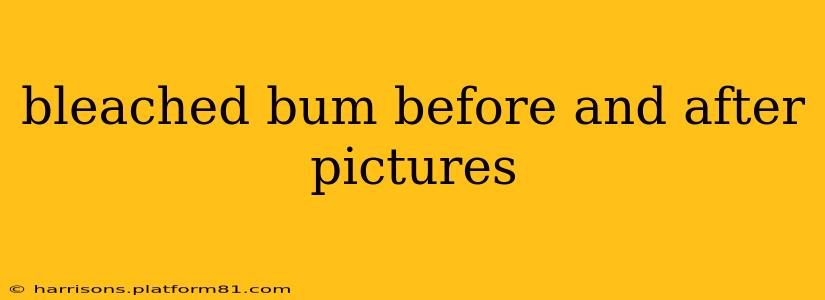 bleached bum before and after pictures