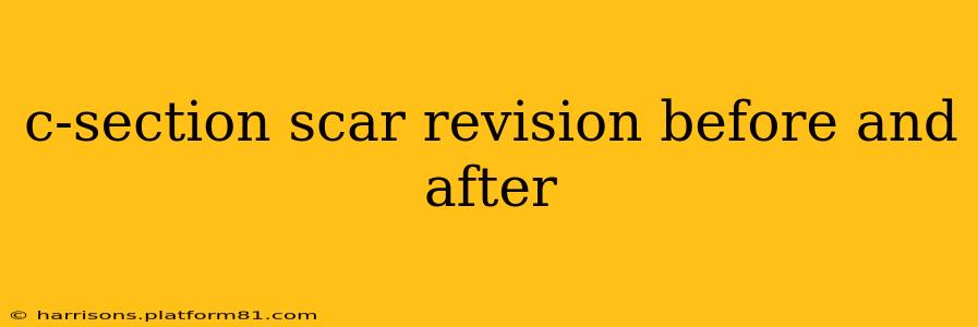 c-section scar revision before and after