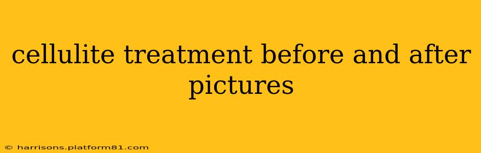 cellulite treatment before and after pictures