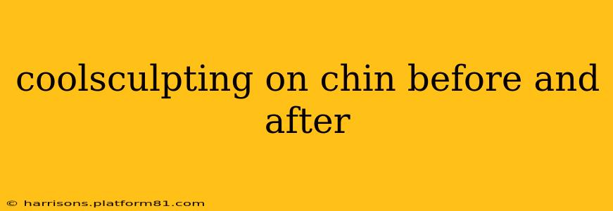 coolsculpting on chin before and after