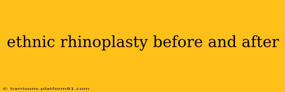 ethnic rhinoplasty before and after