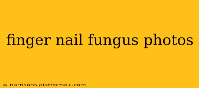 finger nail fungus photos