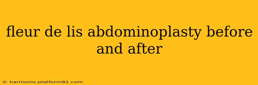 fleur de lis abdominoplasty before and after
