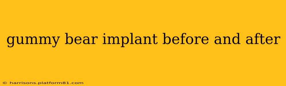 gummy bear implant before and after