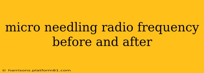 micro needling radio frequency before and after