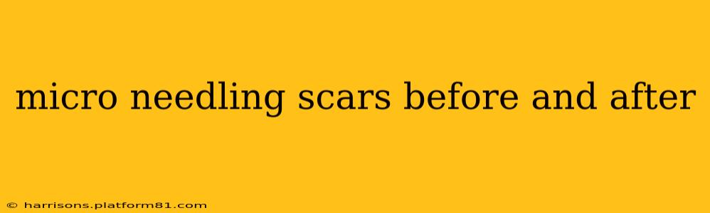micro needling scars before and after