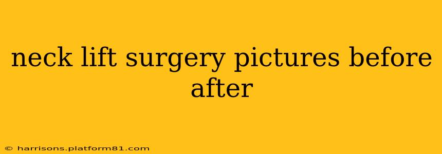 neck lift surgery pictures before after