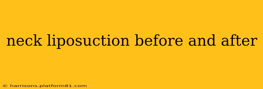 neck liposuction before and after