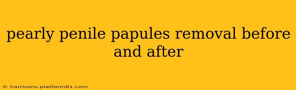 pearly penile papules removal before and after