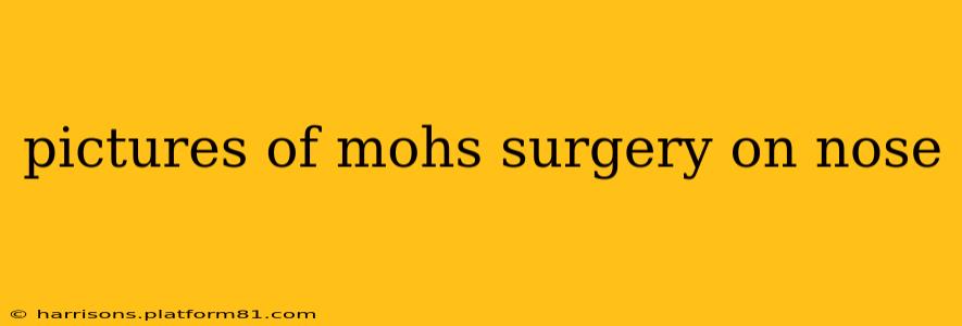 pictures of mohs surgery on nose