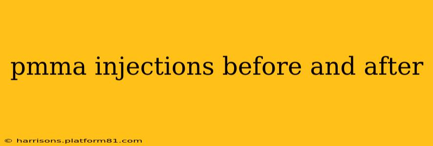 pmma injections before and after
