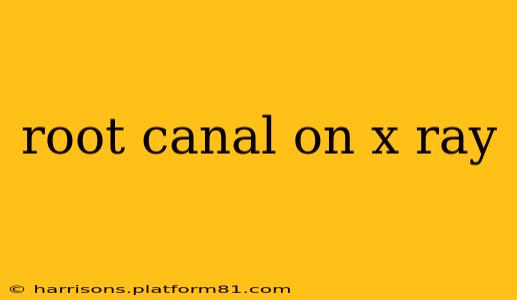 root canal on x ray