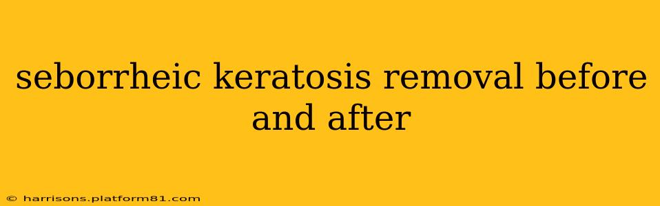 seborrheic keratosis removal before and after