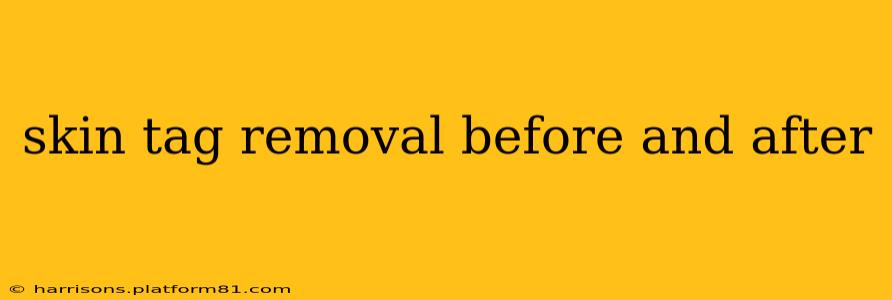 skin tag removal before and after