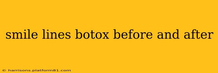 smile lines botox before and after