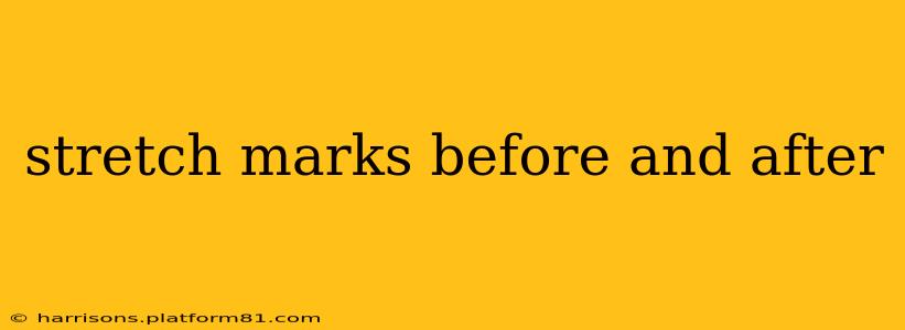 stretch marks before and after