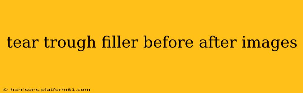 tear trough filler before after images