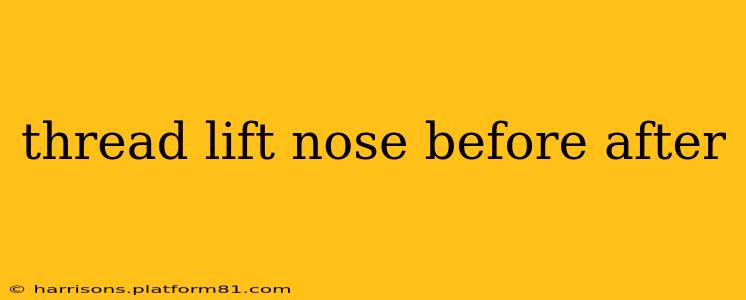 thread lift nose before after