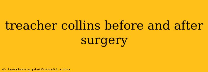treacher collins before and after surgery
