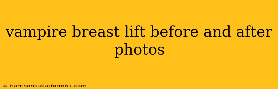 vampire breast lift before and after photos