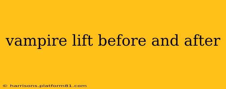 vampire lift before and after