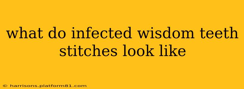 what do infected wisdom teeth stitches look like