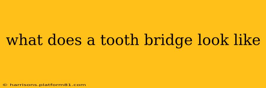 what does a tooth bridge look like